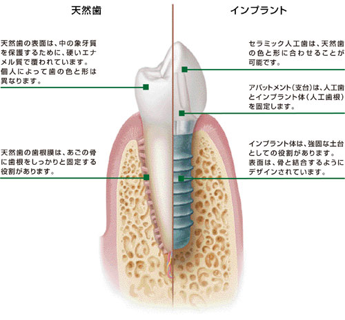 インプラント